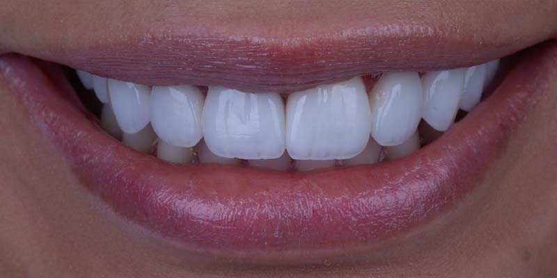 Guida alle Faccette dentali estetiche - Studio Fedi