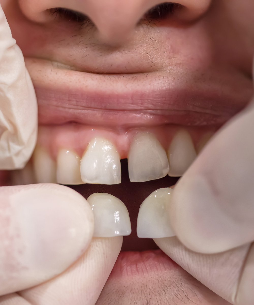 Faccette Dentali Faccette Dentali