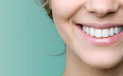 5 Cose da sapere sullo sbiancamento dentale