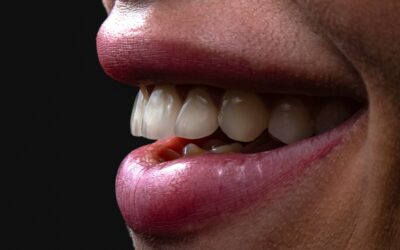 Cosa succede ai denti PRIMA DI MONTARE LE FACCETTE DENTALI?