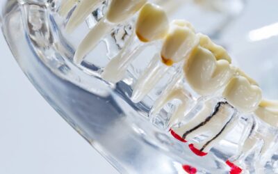 Ho perso un dente: cosa succede se non lo sostituisco?